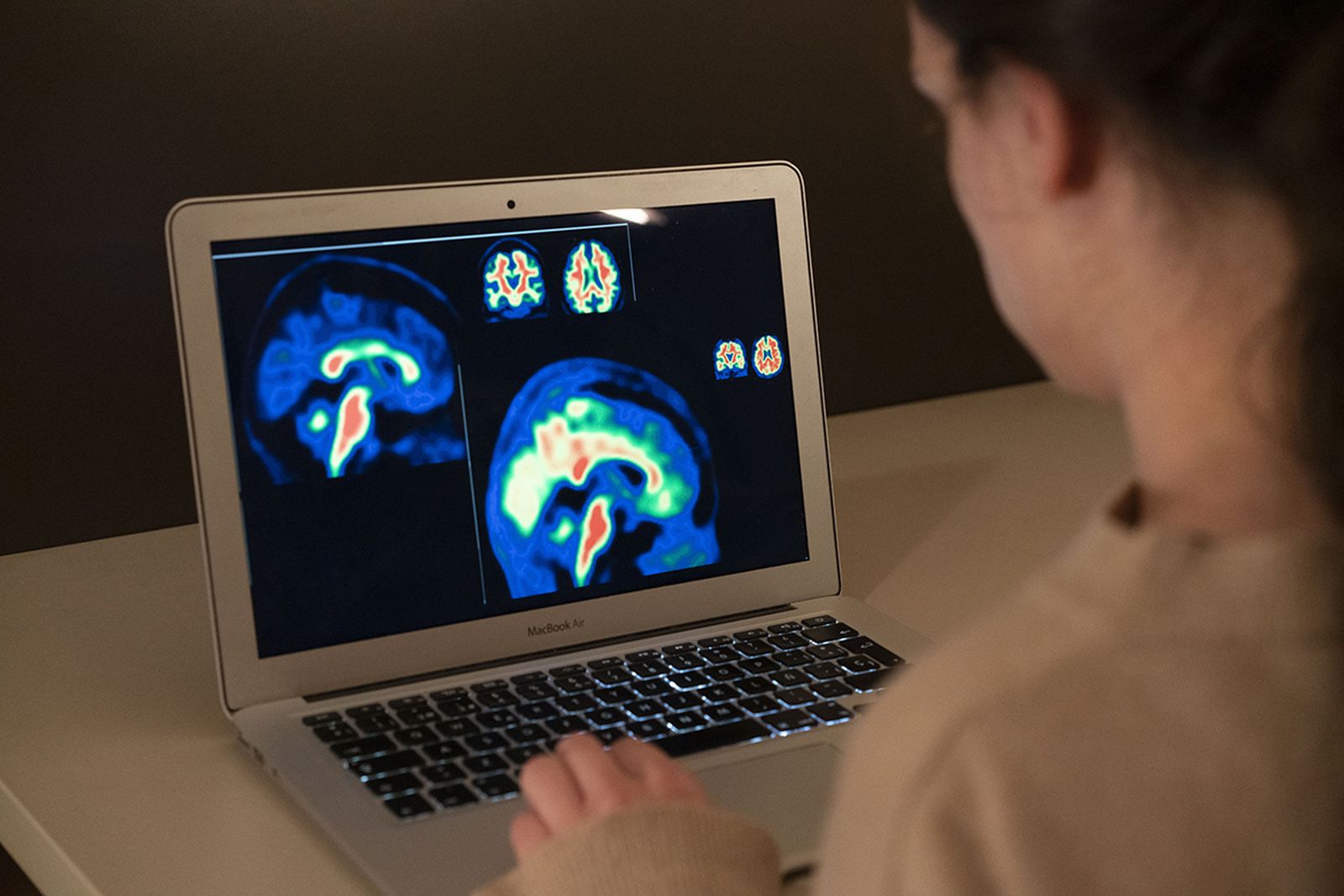 Investigadores europeos mejoran la sensibilidad del diagnóstico de las fases iniciales del Alzheimer