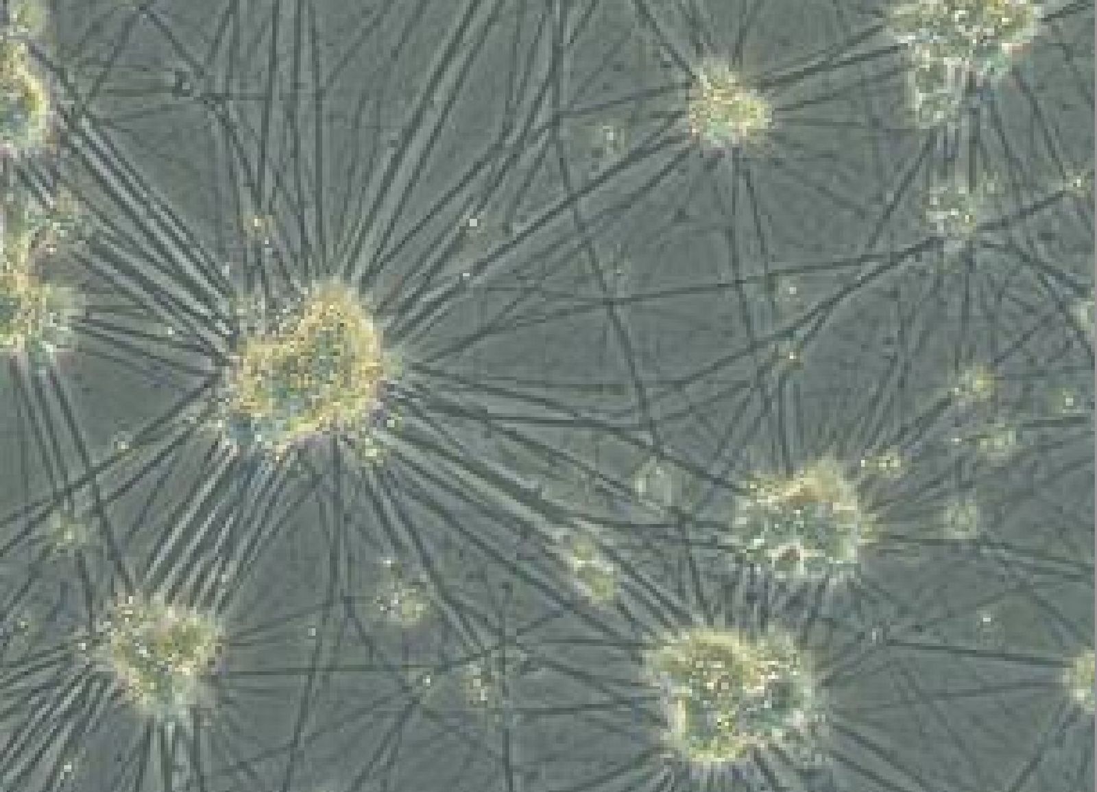 La Caixa impulsa la investigación sobre esta enfermedad